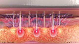 RF Microneedling