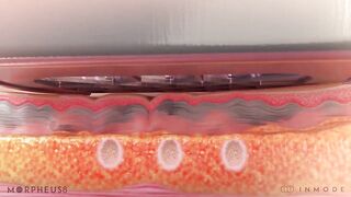 RF Microneedling