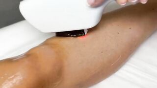 Фотоэпиляция в Лиссабоне / SHR (Super Hair Removal System)