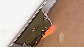 Фотоэпиляция в Лиссабоне / SHR (Super Hair Removal System)