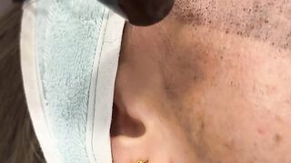 Hollywood Peel (laser carbon peeling) in Beauty Salon "Lisboa Beauty Service"