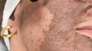 Hollywood Peel (laser carbon peeling) in Beauty Salon "Lisboa Beauty Service"