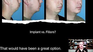 Chin Implant vs. Chin Surgery.  Make the Wise Decision!!!