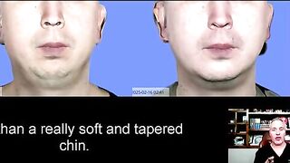 Chin Implant vs. Chin Surgery.  Make the Wise Decision!!!