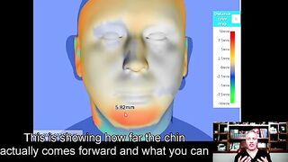 Chin Implant vs. Chin Surgery.  Make the Wise Decision!!!