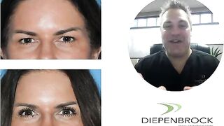Heavy Eyelid Surgery or Blepharoplasty to Remove Extra Skin!!