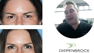 Heavy Eyelid Surgery or Blepharoplasty to Remove Extra Skin!!