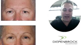 Heavy Eyelid Surgery or Blepharoplasty to Remove Extra Skin!!