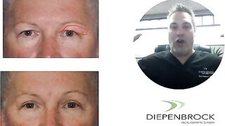 Heavy Eyelid Surgery or Blepharoplasty to Remove Extra Skin!!