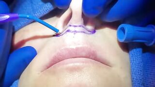 Long/Thin upper lip? Solution: a lip lift. Watch Dr. Diepenbrock and catch a peek at her result!