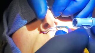 Long/Thin upper lip? Solution: a lip lift. Watch Dr. Diepenbrock and catch a peek at her result!