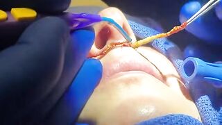 Long/Thin upper lip? Solution: a lip lift. Watch Dr. Diepenbrock and catch a peek at her result!