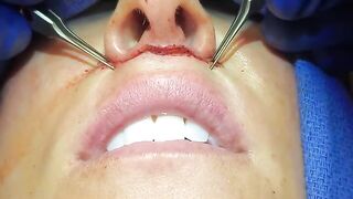 Long/Thin upper lip? Solution: a lip lift. Watch Dr. Diepenbrock and catch a peek at her result!
