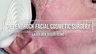 Laser Skin Resurfacing - Satisfying immediate results of your skin tightening, rejuvenate your skin!