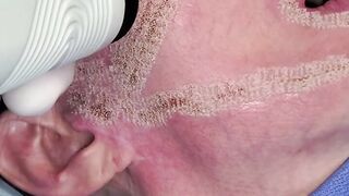 Laser Skin Resurfacing - Satisfying immediate results of your skin tightening, rejuvenate your skin!