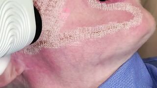 Laser Skin Resurfacing - Satisfying immediate results of your skin tightening, rejuvenate your skin!