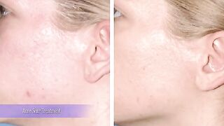 Acne Scar Treatment: what a facial cosmetic surgeon can do for you!