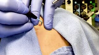 Scarless Mole Removal Using Radiofrequency Energy