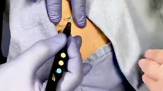 Scarless Mole Removal Using Radiofrequency Energy
