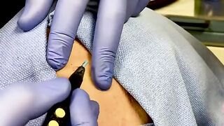 Scarless Mole Removal Using Radiofrequency Energy
