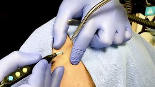 Scarless Mole Removal Using Radiofrequency Energy