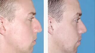 Nose Surgery - Functional and Aesthetic - Dr. D discusses Rhinoplasty Surgery!
