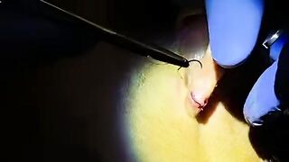 Gauged Ear Repair.  How to Do it with Dr. D