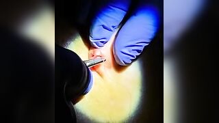Gauged Ear Repair.  How to Do it with Dr. D