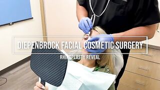 Nose Job (Rhinoplasty) Reveal: 6 days PO - splint removal - **UPDATE** - BEFORE/AFTER