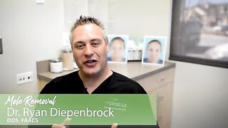 Mole Removal: Before & After and all about if you are a good candidate for this procedure w/ Dr. D.