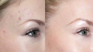 Mole Removal: Before & After and all about if you are a good candidate for this procedure w/ Dr. D.