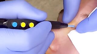 Mole Removal: Before & After and all about if you are a good candidate for this procedure w/ Dr. D.