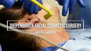 FaceTite and Morpheous 8 Facial Rejuvenation