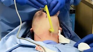 FaceTite and Morpheous 8 Facial Rejuvenation