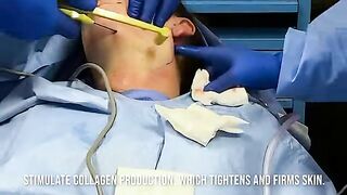FaceTite and Morpheous 8 Facial Rejuvenation