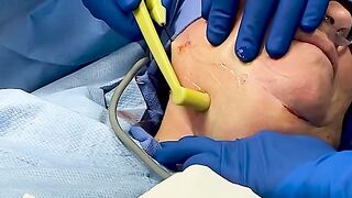 FACEtite with Dr. Diepenbrock Fort Wayne and Warsaw Indiana