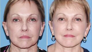 What to Know About Face Lift and Neck lifts: Before and After Photos