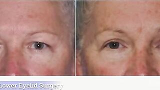 Sagging Eyelids and Eye Bag Surgery:  What to Know About Blepharoplasty Surgery