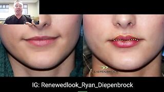 M Shaped Lips Using Filler