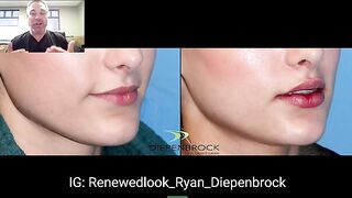 M Shaped Lips Using Filler