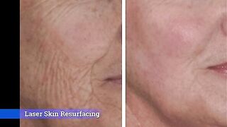 Skin Rejuvenation: Microneedling with PRP, Chemical Peels, and Laser Skin Resurfacing