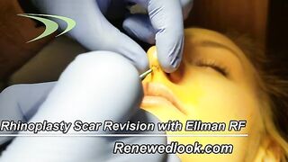Rhinoplasty Scar revision with Ellman Radio Frequency by Cynosure