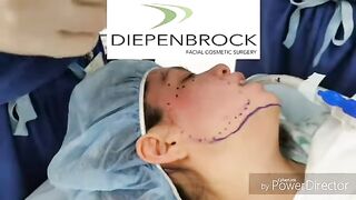 Skin Resurfacing with PRP, Microneedling,  and Laser for Acne Scars