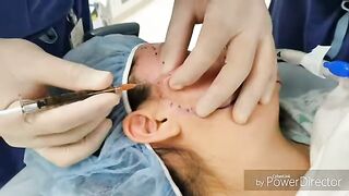 Skin Resurfacing with PRP, Microneedling,  and Laser for Acne Scars