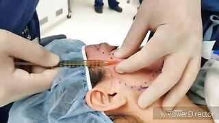 Skin Resurfacing with PRP, Microneedling,  and Laser for Acne Scars