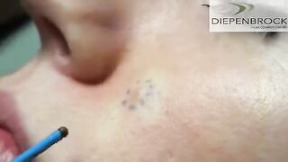 Mole Removal with Ellman RF