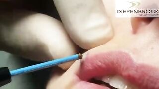Mole Removal with Ellman RF