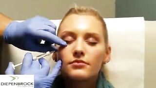 Tear trough fillers by Dr. Diepenbrock Fort Wayne