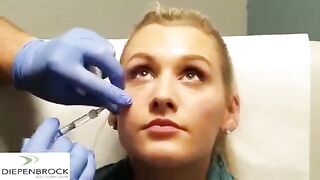 Tear trough fillers by Dr. Diepenbrock Fort Wayne