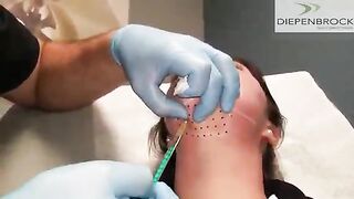 Kybella Injections for Chin and Neck Fullness